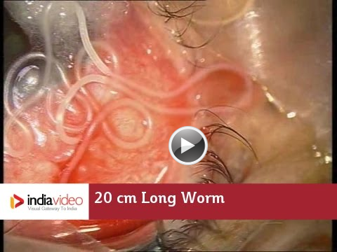 loa loa eye worm